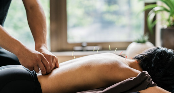 Acupuncture