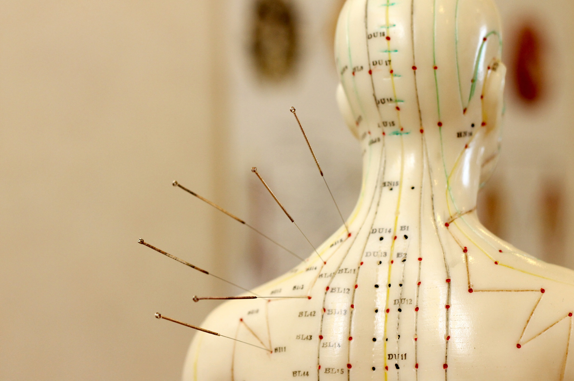 Tailored acupuncture & Fibromyalgia